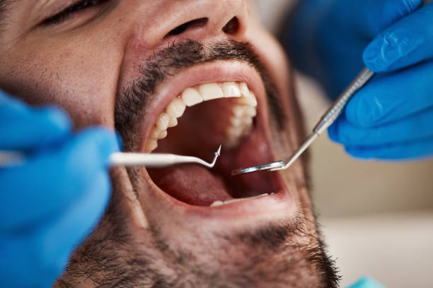 Best Emergency Tooth Extraction in Stevens Point, WI